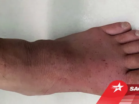 Vì sao nhiều người phát bệnh gút hoặc bị nặng lên sau kỳ nghỉ Tết?