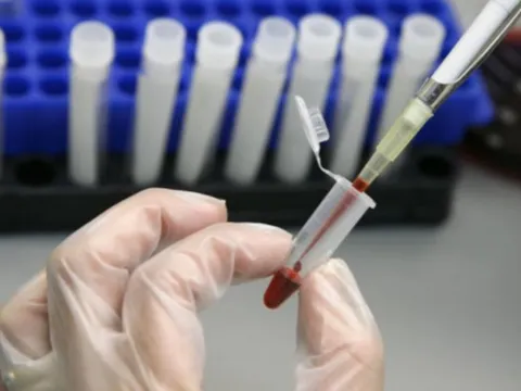 Người phụ nữ đầu tiên trên thế giới được chữa khỏi HIV bằng phương pháp cấy ghép tế bào gốc