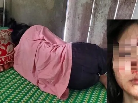 Nữ sinh lớp 10 ở Huế bị bạn cùng trường đánh đến chấn động não