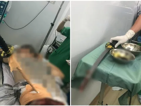 Cứu sống nam thanh niên nhập viện với thanh kiếm đâm xuyên thắt lưng