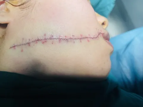 Cãi vã khi nói lời chia tay, cô gái 22 tuổi bị bạn trai chém rách mặt