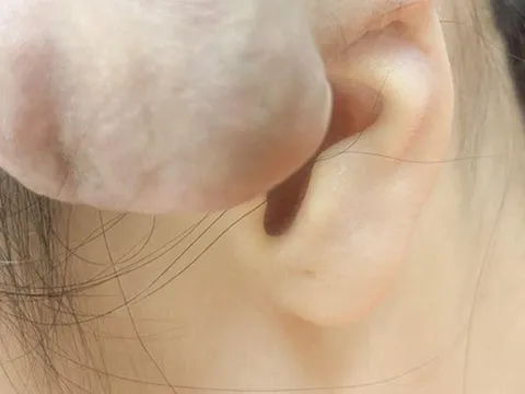 Xỏ khuyên, bấm nhiều lỗ trên vành tai dễ dẫn đến nhiều hệ luỵ