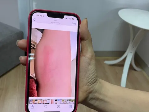 Chi 60 triệu tiêm 'collagen tươi' để làm thẳng chân, bắp chân người phụ nữ biến thành ổ áp xe