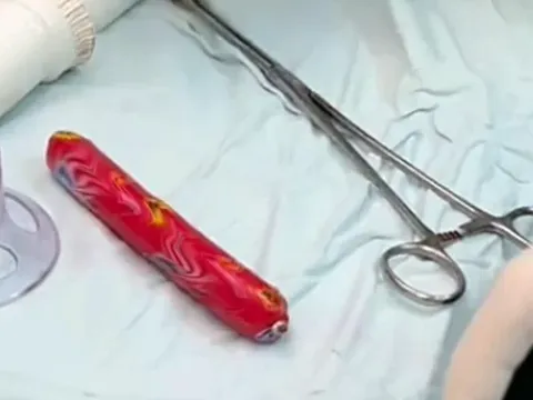 Thanh niên bị kẹt cây xúc xích loại to trong hậu môn vì muốn thử 'cảm giác lạ'