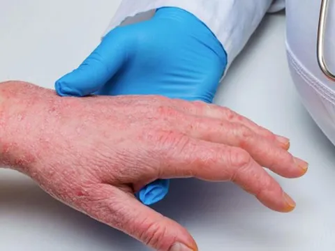 Bộ Y tế hướng dẫn các biện pháp phòng, chống tạm thời với bệnh đậu mùa khỉ