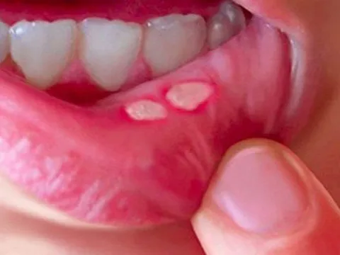 Phân biệt loét miệng với bệnh tay chân miệng
