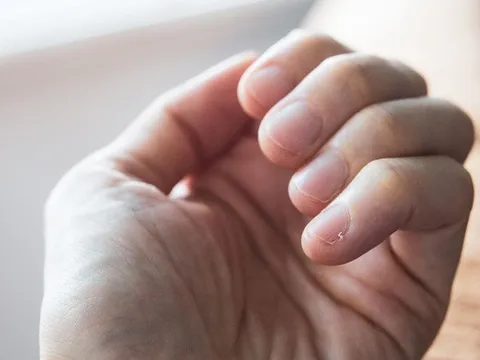 Móng tay trắng hoặc nhợt nhạt có thể là dấu hiệu của bệnh gì?