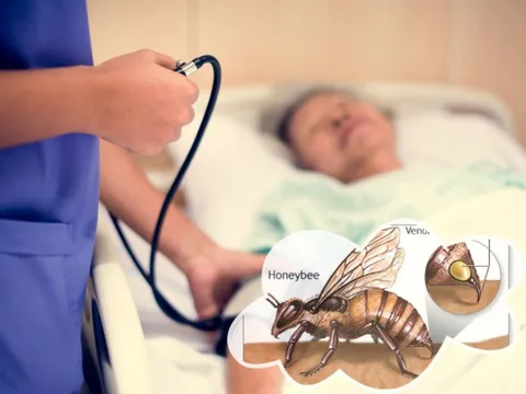 Sau khi bị ong đốt, người phụ nữ bất ngờ bị đột quỵ, nhập viện khẩn
