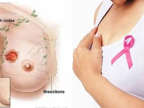 Ung thư có phải là một căn bệnh do di truyền không?