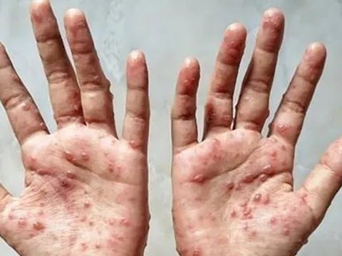 Người nghi mắc bệnh đậu mùa khỉ nên đến bệnh viện xét nghiệm