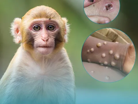 Bộ Y tế ban hành hướng dẫn chẩn đoán, điều trị và phòng bệnh đậu mùa khỉ