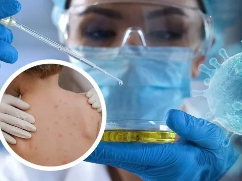 Tăng cường giám sát bệnh đậu mùa khỉ tại các cửa khẩu
