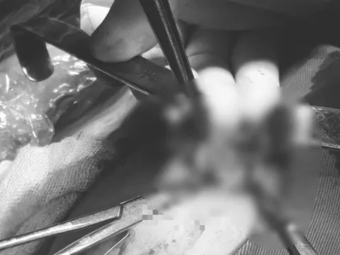 Nữ bệnh nhân 21 tuổi được phát hiện 3 khối u xơ vú