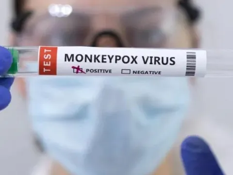 Anh phát hiện biến chủng thứ 2 của virus đậu mùa khỉ