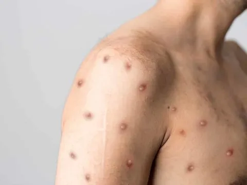TP.HCM ghi nhận ca đậu mùa khỉ đầu tiên