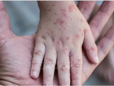 Bệnh đậu mùa khỉ lây truyền như thế nào và các dấu hiệu nhận biết