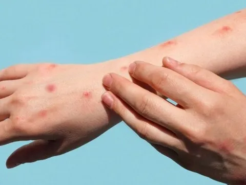 Bệnh đậu mùa khỉ có dễ lây nhiễm không?