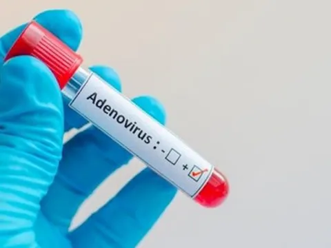Khi nào nên xét nghiệm Adenovirus cho trẻ?