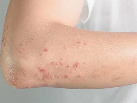 WHO lần đầu tiên xác định các bệnh về nấm là mối đe dọa với sức khỏe con người