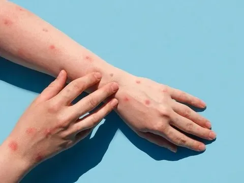 Bộ Y tế xếp bệnh đậu mùa khỉ vào danh mục bệnh truyền nhiễm nhóm B