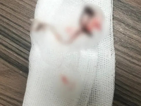 Hy hữu người phụ nữ ăn cá bị hóc lưỡi câu, nhập viện khẩn