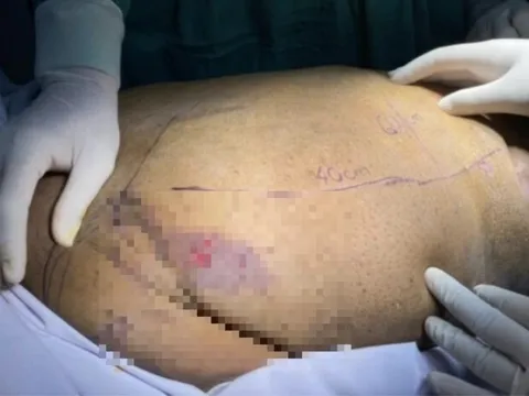 Người phụ nữ mắc căn bệnh hiếm khiến có hình dạng như mang mai rùa trên lưng