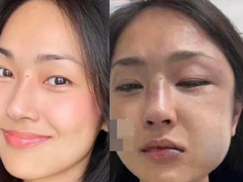 Một MC nổi tiếng bị người yêu đánh sưng mặt trong ngày sinh nhật vì nghi ngờ bạn trai lăng nhăng