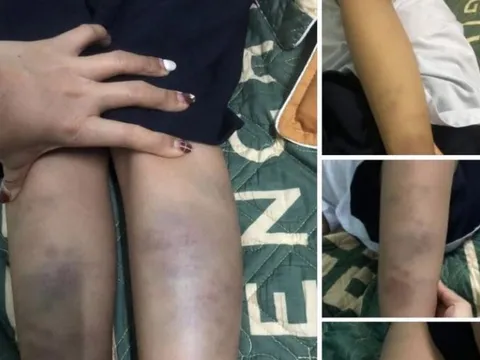 Vụ học sinh lớp 1 bị đánh bầm tím chân tay ở trường: Không khởi tố vụ án hình sự