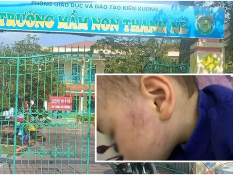 Phụ huynh phẫn nộ vụ bé trai 2 tuổi bị cô giáo mầm non tát bầm tím một bên má