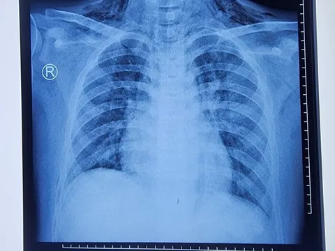 Cậu bé 11 tuổi vẫn bị hóc sặc dị vật, bác sĩ đưa ra khuyến cáo