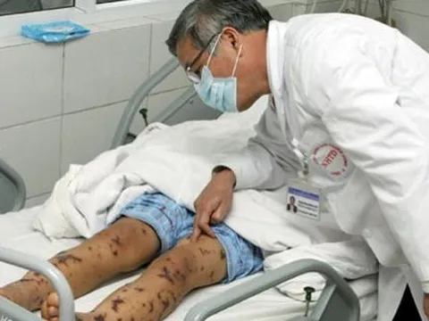 Bộ Y tế ra công văn 'nóng' về bệnh viêm cầu lợn