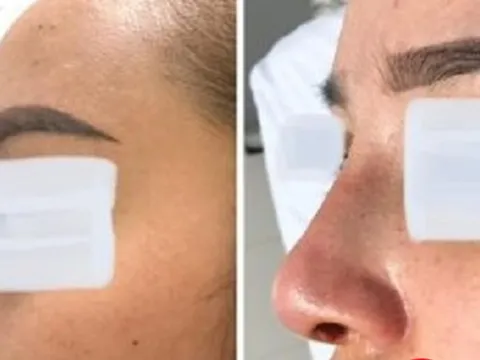Cô gái 26 tuổi bị áp xe sau khi phẫu thuật nâng mũi