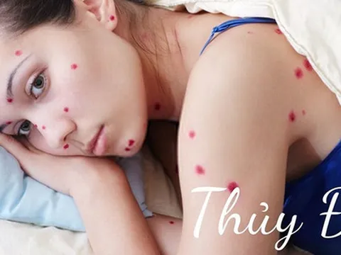Bệnh thủy đậu đang bùng phát: Bị thủy đậu bao nhiêu ngày thì khỏi, có bị lại lần 2 không?