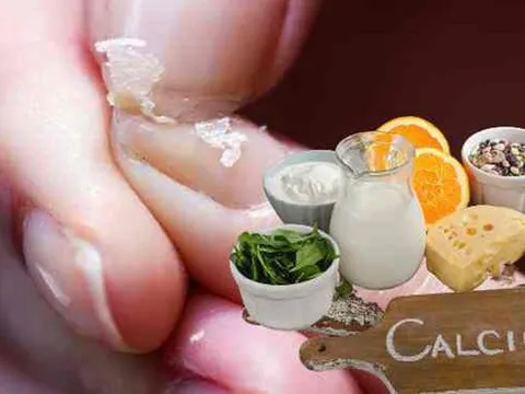Chuyên gia dinh dưỡng chỉ ra 8 dấu hiệu thiếu canxi dễ nhận thấy nhất
