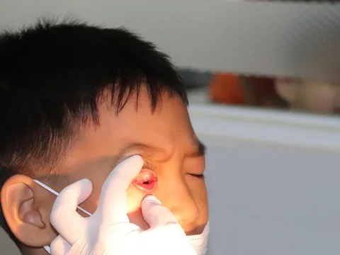 Dịch đau mắt đỏ lan rộng trên cả nước