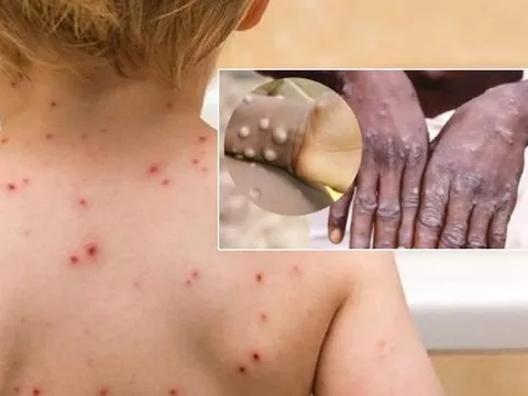 Bộ Y tế chỉ đạo không để lây nhiễm chéo bệnh đậu mùa khỉ