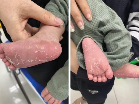 Bé trai 3 tháng tuổi mắc bệnh giang mai vì 1 nguyên nhân không ngờ