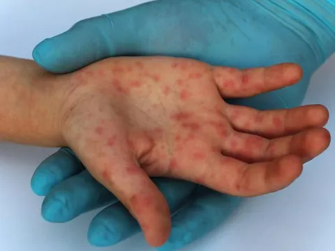 TP.HCM ghi nhận 19 ca bệnh đậu mùa khỉ