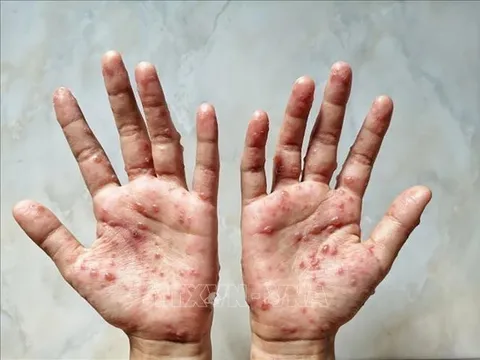 Bến Tre phát hiện ca bệnh đậu mùa khỉ đầu tiên