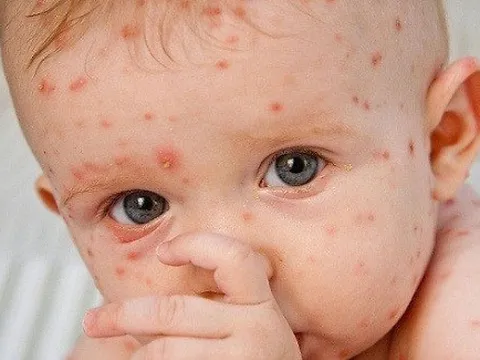 WHO: Số ca mắc bệnh sởi tăng gấp 30 lần tại châu Âu