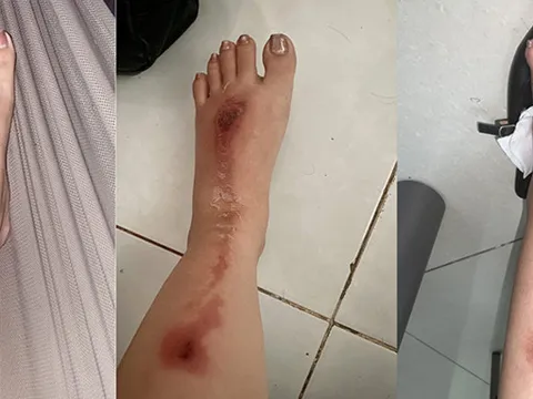 TP HCM: Người phụ nữ bị bỏng nặng do bắn pháo hoa mừng tiệc tất niên