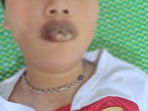 Hải Phòng: Bé 11 tuổi phải nhập viện do gia đình tự ý dùng thuốc điều trị tại nhà