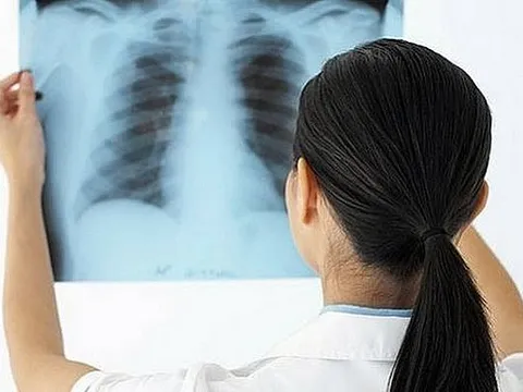 Bộ Y tế ban hành Hướng dẫn chẩn đoán, điều trị và dự phòng bệnh lao