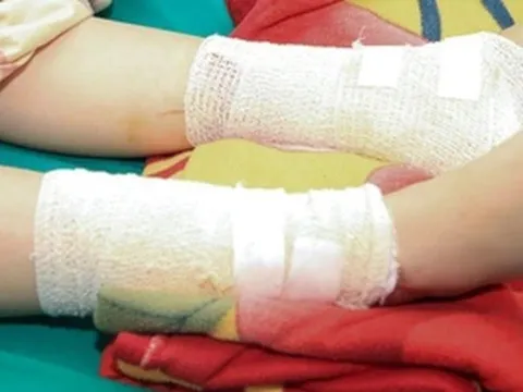 Bé gái 4 tuổi bị lửa cồn đốt bỏng nặng khắp người