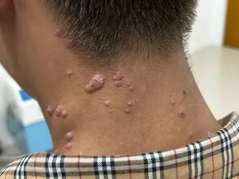 Đồng Nai thêm 1 ca nghi mắc bệnh đậu mùa khỉ