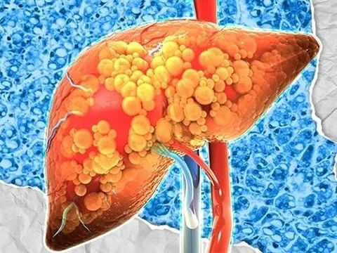 FDA Mỹ phê duyệt thuốc đầu tiên chữa viêm gan nhiễm mỡ không do rượu