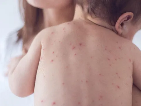 Hà Nội đã ghi nhận ca mắc rubella đầu tiên trong năm 2024