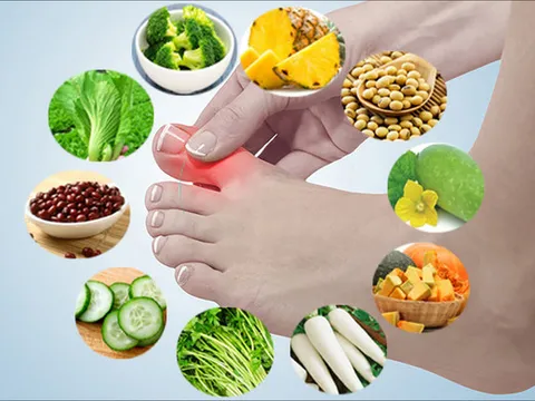 7 thực phẩm giúp kiểm soát nồng độ axit uric cho người bị gút