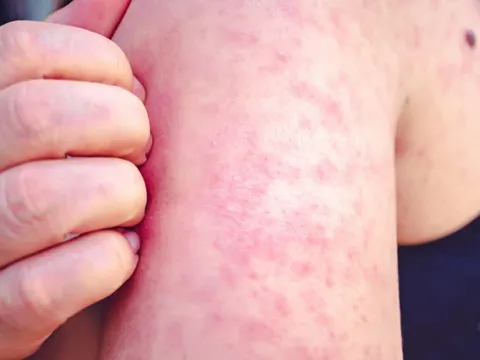 Hà Nội ghi nhận ca mắc sởi đầu tiên trong năm