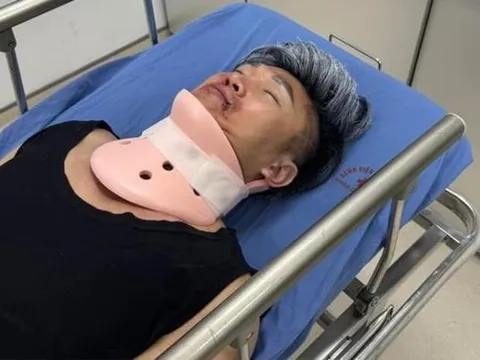 Tình hình sức khoẻ của nam ca sĩ bị thương nặng, mặt bầm tím phải cấp cứu hiện ra sao?